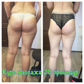 Антицеллюлитный пассаж