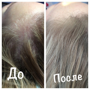 Мезотерапия волос