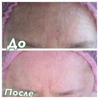 Детокс кожи