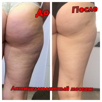 Антицеллюлитный массаж