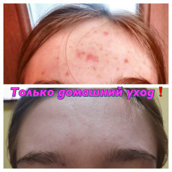 Лечение подростковых угрей