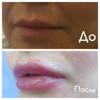 Увеличение губ