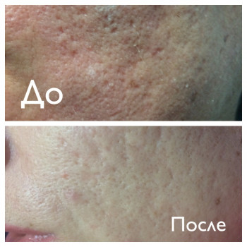 Лечение рубцов