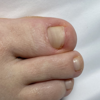 Аппаратный педикюр,зачистка анихолизиса