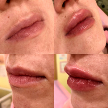 Корекція форми губ - Контурна пластика
                    Врач-косметолог Неля Константиновна Киев