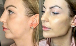 Контурная пластика лица Full Face Врач-косметолог Юлия Харьков
