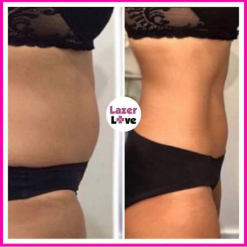 "До-После" курса аппаратного массажа