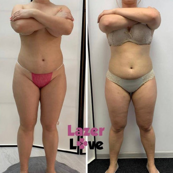 "До-После" курса аппаратного массажа