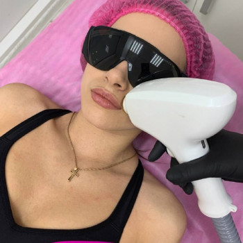 Лазерная эпиляция (все зоны, подходит для любого типа кожи и