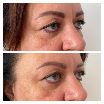 Испанский миофасциальный массаж лица
                    Масажист Татьяна Одеса