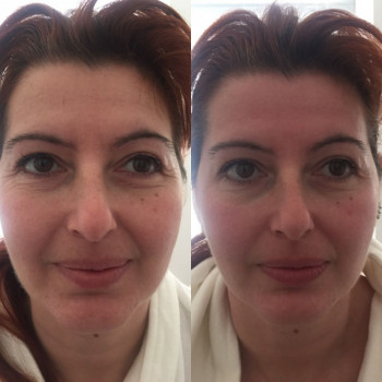 Испанский миофасциальный массаж лица
                    Масажист Татьяна Одеса