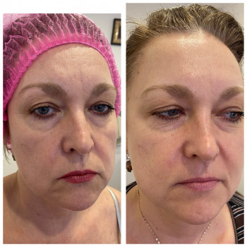 Испанский миофасциальный массаж лица
                    Масажист Татьяна Одеса