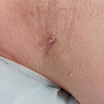 Видалення новоутворень
                    Косметолог Мария Київ