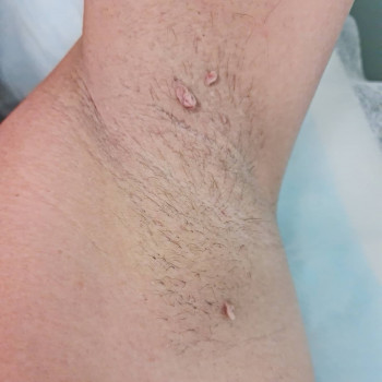 Видалення новоутворень
                    Косметолог Мария Київ