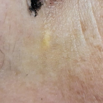 Видалення новоутворень
                    Косметолог Мария Київ