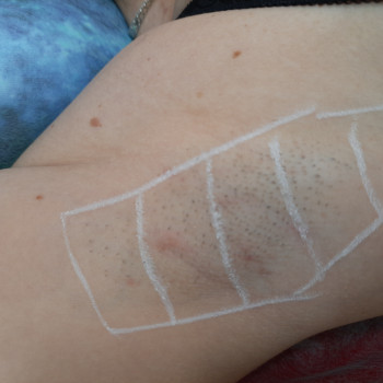 Процедура "до" и сразу "после". Эпиляция подмышечные впадины