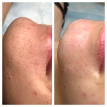 Результат до и после процедуры механической чистки лица. Обр