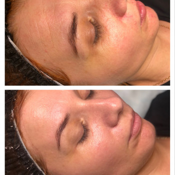 Результат до и после процедуры массажа лица + увлажняющий ух