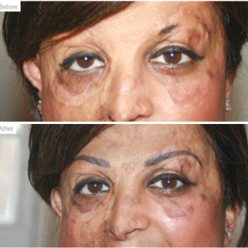 Бесплатно при увечьях на лице после ожогов или ДТП