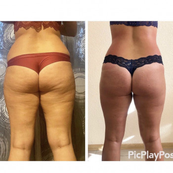 ЛЕПКА Ручной антицеллюлитный массаж
                    СПА-салон GARNA Мариуполь