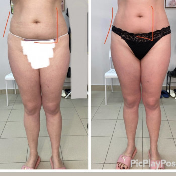 ЛЕПКА Ручной антицеллюлитный массаж
                    СПА-салон GARNA Мариуполь