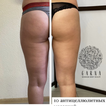 ЛЕПКА Ручной антицеллюлитный массаж
                    СПА-салон GARNA Мариуполь