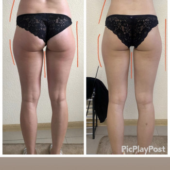 ЛЕПКА Ручной антицеллюлитный массаж
                    СПА-салон GARNA Мариуполь