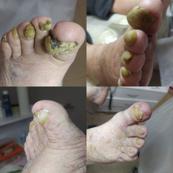 Робота з грибковим нігтем
                    Подолог Татьяна Викторовна Запорожье