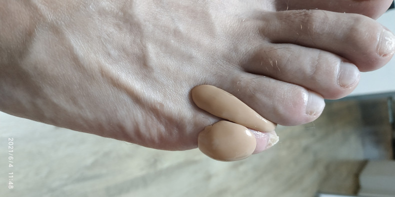 Силиконовый ортез, решает сразу две проблемы: мозоль на мизи, фото - Подолог Веста Меладзе