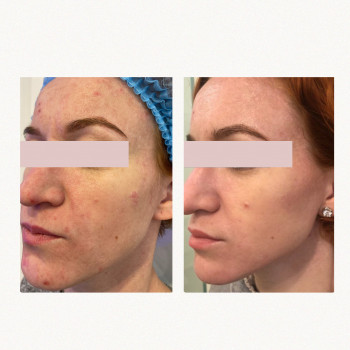 Лазерний пілінг (одна процедура)