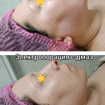 Электромезопорация