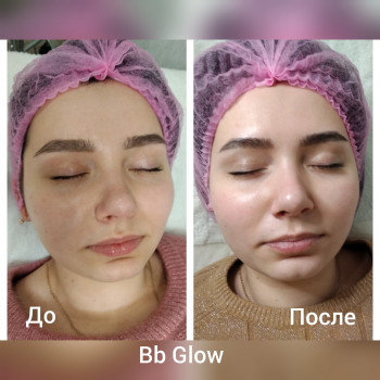 BB Glow результат 4-х процедур