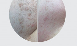 Салициловый пилинг бикини Мастер депиляции Ольга Чернигов