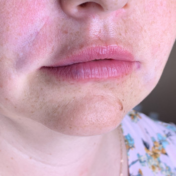 Увеличение губ , очень нежно и естественно