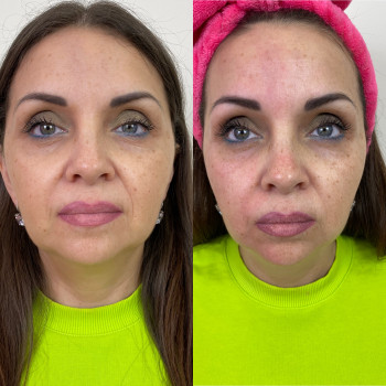 Фракционный РФ лифтинг
                    Косметологический центр Imbir studio Одесса