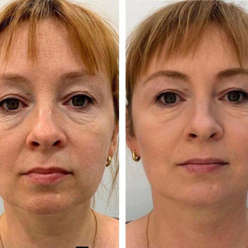 Смас лифтинг 4-d
                    Косметологический центр Imbir studio Одесса