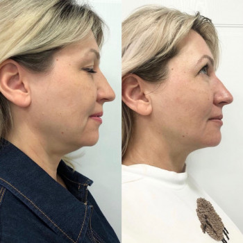 Смас лифтинг 4-d
                    Косметологический центр Imbir studio Одесса