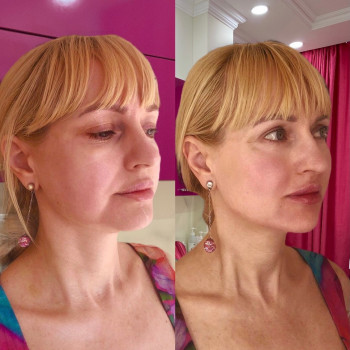 Смас лифтинг 4-d
                    Косметологический центр Imbir studio Одесса