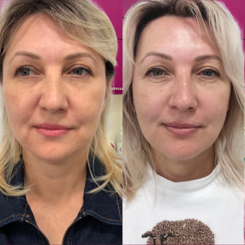 Смас лифтинг 4-d
                    Косметологический центр Imbir studio Одесса