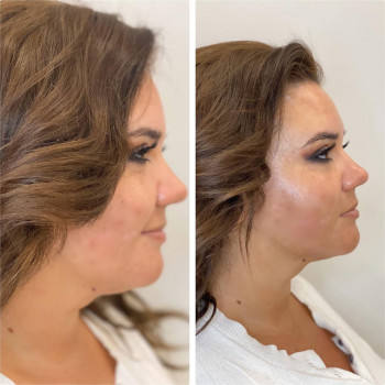 Смас лифтинг 4-d
                    Косметологический центр Imbir studio Одесса