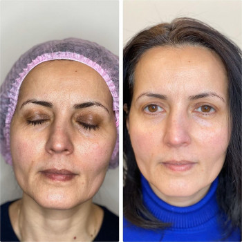 Смас лифтинг 4-d
                    Косметологический центр Imbir studio Одесса