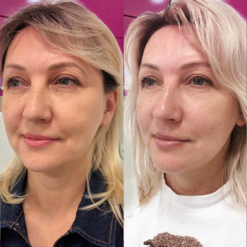 Смас лифтинг 4-d
                    Косметологический центр Imbir studio Одесса