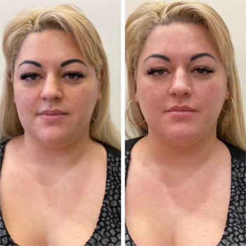 Смас лифтинг 4-d
                    Косметологический центр Imbir studio Одесса