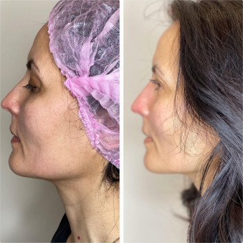 Смас лифтинг 4-d
                    Косметологический центр Imbir studio Одесса