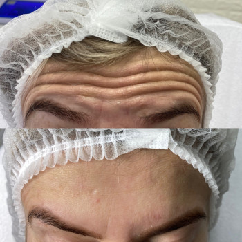 Ботулінотерапія