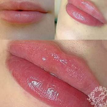 Увеличение губ