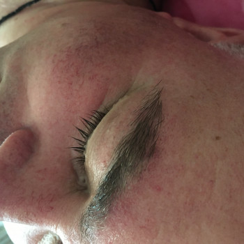 До процедуры «огонь и лёд»