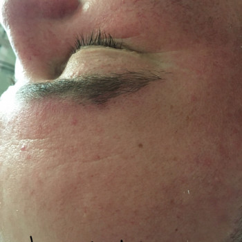 После процедуры «огонь и лёд»