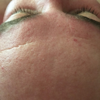 После процедуры «огонь и лёд»