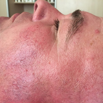 До процедуры «огонь и лёд»